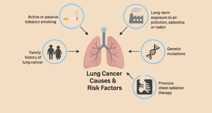 Lung Cancer Causes Lung Cancer Causes