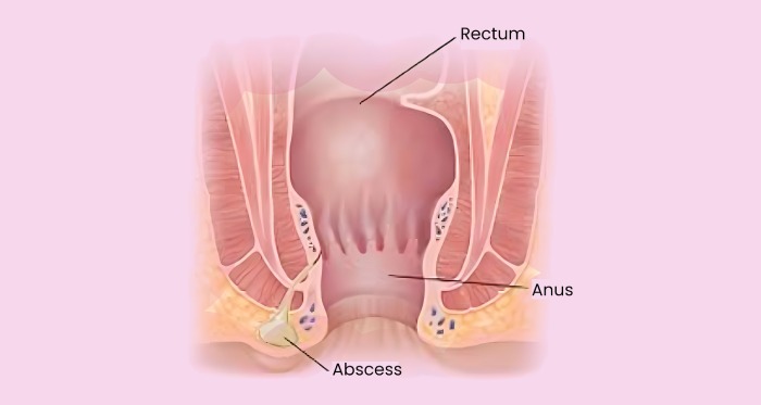 anal-fistula-caus dr ranajoy dutta / thyroid cancer / symtoms-img