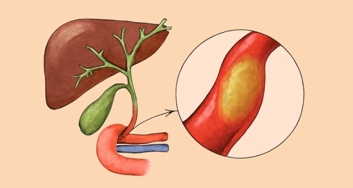 Bile Duct Cancer Causes Bile Duct Cancer Causes