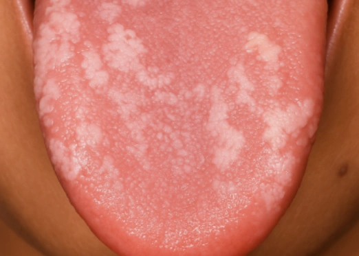 Common Signs of Oral Cancer