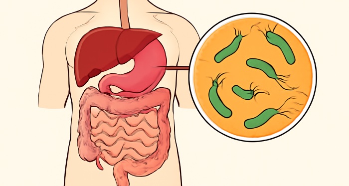 Stomach Cancer Causes Stomach Cancer Causes
