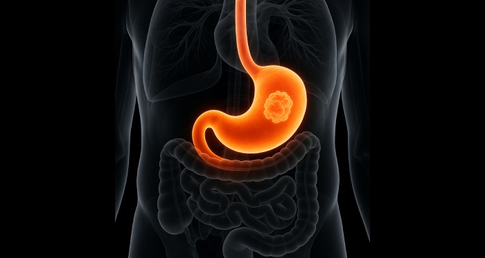 Stomach Surgery Causes