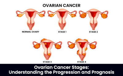 Ovarian Cancer Stages: Understanding the Progression and Prognosis
