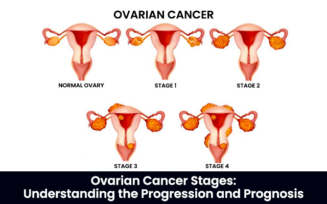 Ovarian Cancer Stages: Understanding the Progression and Prognosis